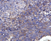 IHC staining of FFPE human lung cancer tissue with FGFR2 antibody. HIER: boil tissue sections in pH8 EDTA for 20 min and allow to cool before testing.