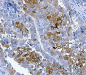 IHC staining of FFPE human liver cancer tissue with FGFR2 antibody. HIER: boil tissue sections in pH8 EDTA for 20 min and allow to cool before testing.