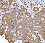 IHC staining of FFPE human rectal cancer tissue with FKBP1A/B antibody. HIER: boil tissue sections in pH8 EDTA for 20 min and allow to cool before testing.