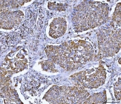 IHC staining of FFPE human lung cancer tissue with GLUD1/2 antibody. HIER: boil tissue sections in pH8 EDTA for 20 min and allow to cool before testing.
