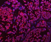 Immunofluorescent staining of FFPE human breast cancer tissue with GLUD1/2 antibody (red) and DAPI nuclear stain (blue). HIER: boil tissue sections in pH8 EDTA for 20 min and allow to cool before testing.