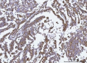 IHC staining of FFPE human ovarian cancer tissue with GLUD1/2 antibody. HIER: boil tissue sections in pH8 EDTA for 20 min and allow to cool before testing.