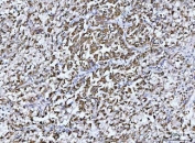IHC staining of FFPE human liver cancer tissue with GLUD1/2 antibody. HIER: boil tissue sections in pH8 EDTA for 20 min and allow to cool before testing.