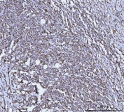 IHC staining of FFPE human lymphoma tissue with GLUD1/2 antibody. HIER: boil tissue sections in pH8 EDTA for 20 min and allow to cool before testing.