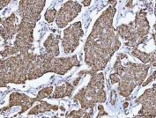 IHC staining of FFPE human breast cancer tissue with GLUD1/2 antibody. HIER: boil tissue sections in pH8 EDTA for 20 min and allow to cool before testing.