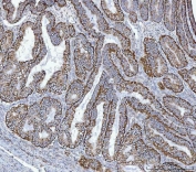 IHC staining of FFPE human endometrial cancer tissue with GLUD1/2 antibody. HIER: boil tissue sections in pH8 EDTA for 20 min and allow to cool before testing.