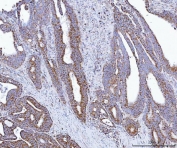 IHC staining of FFPE human rectal cancer tissue with GLUD1/2 antibody. HIER: boil tissue sections in pH8 EDTA for 20 min and allow to cool before testing.