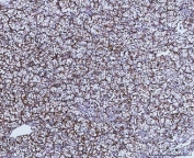 IHC staining of FFPE human renal carcinoma tissue with GLUD1/2 antibody. HIER: boil tissue sections in pH8 EDTA for 20 min and allow to cool before testing.