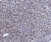 IHC staining of FFPE human renal carcinoma tissue with GLUD1/2 antibody. HIER: boil tissue sections in pH8 EDTA for 20 min and allow to cool before testing.