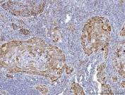 IHC staining of FFPE human gallbladder carcinoma tissue with GLUD1/2 antibody. HIER: boil tissue sections in pH8 EDTA for 20 min and allow to cool before testing.
