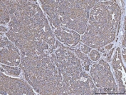 IHC staining of FFPE human liver cancer tissue with IRS2 antibody. HIER: boil tissue sections in pH8 EDTA for 20 min and allow to cool before testing.