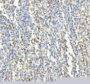 IHC staining of FFPE human lung cancer tissue with Insulin receptor substrate 2 antibody. HIER: boil tissue sections in pH8 EDTA for 20 min and allow to cool before testing.