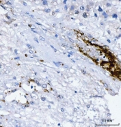 IHC staining of FFPE human liver cancer tissue with CD61 antibody. HIER: boil tissue sections in pH8 EDTA for 20 min and allow to cool before testing.