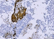 IHC staining of FFPE human lung cancer tissue with CD61 antibody. HIER: boil tissue sections in pH8 EDTA for 20 min and allow to cool before testing.