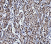 IHC staining of FFPE human liver cancer tissue with KMO antibody. HIER: boil tissue sections in pH8 EDTA for 20 min and allow to cool before testing.