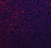 Immunofluorescent staining of FFPE human lymphoma tissue with Mitochondrial fission factor antibody (red) and DAPI nuclear stain (blue). HIER: steam section in pH8 EDTA buffer for 20 min.