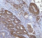 IHC staining of FFPE human rectal cancer tissue with Mitochondrial fission factor antibody. HIER: boil tissue sections in pH8 EDTA for 20 min and allow to cool before testing.