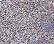 IHC staining of FFPE human lymphoma tissue with Mitochondrial fission factor antibody. HIER: boil tissue sections in pH8 EDTA for 20 min and allow to cool before testing.