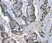 IHC staining of FFPE human colonic adenocarcinoma tissue with Ki-67 antibody. HIER: boil tissue sections in pH8 EDTA for 20 min and allow to cool before testing.