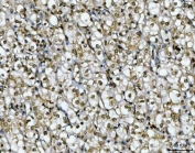 IHC staining of FFPE human renal carcinoma tissue with Ki-67 antibody. HIER: boil tissue sections in pH8 EDTA for 20 min and allow to cool before testing.