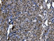 IHC staining of FFPE human lung cancer tissue with Ki-67 antibody. HIER: boil tissue sections in pH8 EDTA for 20 min and allow to cool before testing.