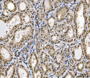 IHC staining of FFPE human thyroid cancer tissue with MRE11 antibody. HIER: boil tissue sections in pH8 EDTA for 20 min and allow to cool before testing.