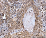 IHC staining of FFPE human laryngeal squamous cell carcinoma tissue with MRE11 antibody. HIER: boil tissue sections in pH8 EDTA for 20 min and allow to cool before testing.