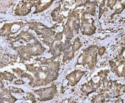 IHC staining of FFPE human rectal cancer tissue with MRE11 antibody. HIER: boil tissue sections in pH8 EDTA for 20 min and allow to cool before testing.
