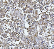 IHC staining of FFPE human gastric cancer tissue with MTSS1 antibody. HIER: boil tissue sections in pH8 EDTA for 20 min and allow to cool before testing.