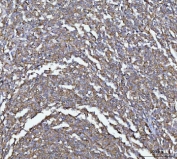 IHC staining of FFPE human lymphoma tissue with MTSS1 antibody. HIER: boil tissue sections in pH8 EDTA for 20 min and allow to cool before testing.