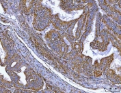 IHC staining of FFPE human endometrial cancer tissue with MTSS1 antibody. HIER: boil tissue sections in pH8 EDTA for 20 min and allow to cool before testing.
