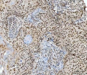IHC staining of FFPE human laryngeal squamous carcinoma tissue with RING2 antibody. HIER: boil tissue sections in pH8 EDTA for 20 min and allow to cool before testing.