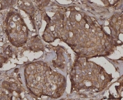 IHC staining of FFPE human breast cancer tissue with Synaptosomal-associated protein 23 antibody. HIER: boil tissue sections in pH8 EDTA for 20 min and allow to cool before testing.