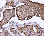 IHC staining of FFPE human breast cancer tissue with Synaptosomal-associated protein 23 antibody. HIER: boil tissue sections in pH8 EDTA for 20 min and allow to cool before testing.