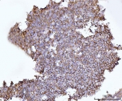 IHC staining of FFPE human lymphoma tissue with Synaptosomal-associated protein 23 antibody. HIER: boil tissue sections in pH8 EDTA for 20 min and allow to cool before testing.