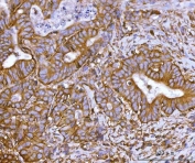 IHC staining of FFPE human rectal cancer tissue with Synaptosomal-associated protein 23 antibody. HIER: boil tissue sections in pH8 EDTA for 20 min and allow to cool before testing.