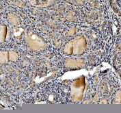 IHC staining of FFPE human thyroid cancer tissue with STAT6 antibody, HRP-labeled secondary and DAB substrate. HIER: boil tissue sections in pH8 EDTA for 20 min and allow to cool before testing.