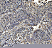 IHC staining of FFPE human laryngeal squamous cell carcinoma tissue with STAT6 antibody, HRP-labeled secondary and DAB substrate. HIER: boil tissue sections in pH8 EDTA for 20 min and allow to cool before testing.