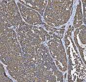 IHC staining of FFPE human liver cancer tissue with TOMM20 antibody. HIER: boil tissue sections in pH8 EDTA for 20 min and allow to cool before testing.