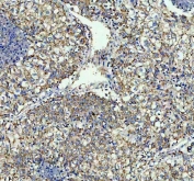 IHC staining of FFPE human lung cancer tissue with TOMM20 antibody. HIER: boil tissue sections in pH8 EDTA for 20 min and allow to cool before testing.
