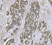 IHC staining of FFPE human rectal cancer tissue with TOMM20 antibody. HIER: boil tissue sections in pH8 EDTA for 20 min and allow to cool before testing.