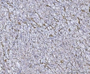 IHC staining of FFPE human renal cancer tissue with von Willebrand Factor antibody. HIER: boil tissue sections in pH8 EDTA for 20 min and allow to cool before testing.