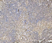 IHC staining of FFPE human lung cancer tissue with XIAP associated factor 1 antibody. HIER: boil tissue sections in pH8 EDTA for 20 min and allow to cool before testing.