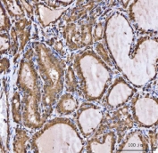 IHC staining of FFPE human thyroid cancer tissue with XIAP associated factor 1 antibody. HIER: boil tissue sections in pH8 EDTA for 20 min and allow to cool before testing.