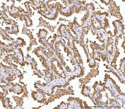 IHC staining of FFPE human adenocarcinoma of lung tissue with Alkyl-DHAP synthase antibody. HIER: boil tissue sections in pH8 EDTA for 20 min and allow to cool before testing.