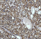 IHC staining of FFPE human liver cancer tissue with Alkyl-DHAP synthase antibody. HIER: boil tissue sections in pH8 EDTA for 20 min and allow to cool before testing.