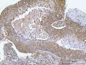 IHC staining of FFPE human esophageal squamous cell carcinoma tissue with Alkyl-DHAP synthase antibody. HIER: boil tissue sections in pH8 EDTA for 20 min and allow to cool before testing.