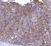 IHC staining of FFPE human cervical cancer tissue with Alkyl-DHAP synthase antibody. HIER: boil tissue sections in pH8 EDTA for 20 min and allow to cool before testing.