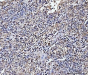 IHC staining of FFPE human glioma tissue with ATP1B2 antibody. HIER: boil tissue sections in pH8 EDTA for 20 min and allow to cool before testing.