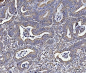 IHC staining of FFPE human rectal cancer tissue with ATP5A1 antibody. HIER: boil tissue sections in pH8 EDTA for 20 min and allow to cool before testing.